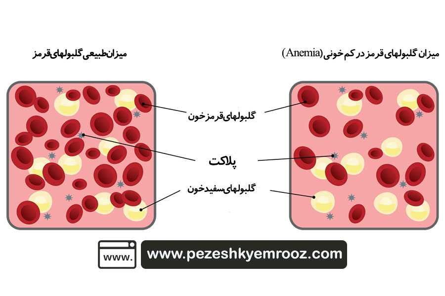کم خونی| آنمی| قلب| گوارش| علائم وجود کم خونی فقر آهن